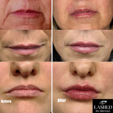 No Needle Lip Filler